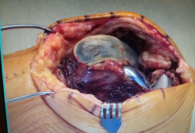 Insides of knee