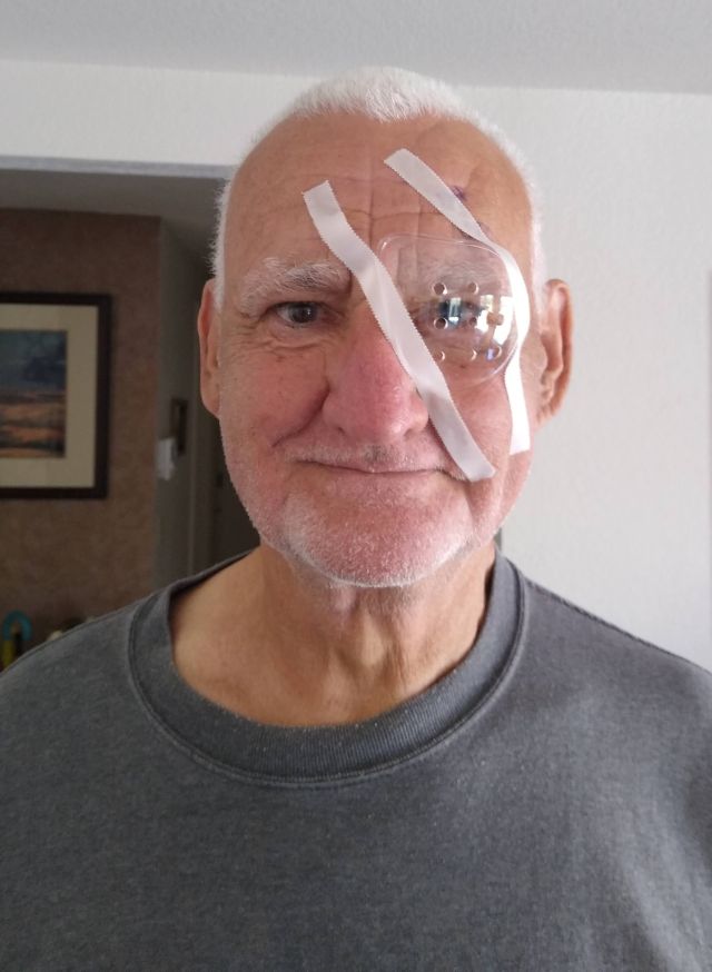 Jim cataract